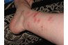 Tell If You Have Bed Bugs