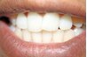 Insert the fangs over your Lateral Incisors or your Canine teeth.