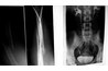 Abdomen X-ray