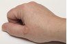 Blistering can occur