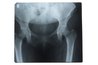 X-ray of pelvis