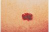 Malignant melanoma