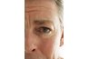 There is a link between milia and under-eye wrinkles.