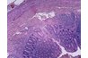 Microscopic image of an inflamed appendix