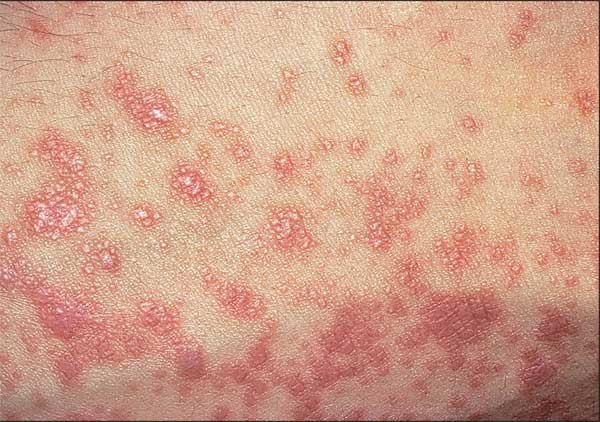 Lichen planus is characterized by what looks like red, mucus-filled bumps on the scalp