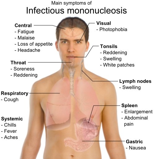 Severe mono in adults