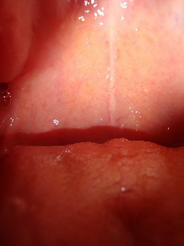 infections in adults Throat