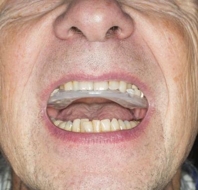 Invisalign braces.