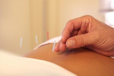 Acupuncture.