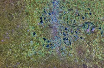Microscopic view of lymphoma.