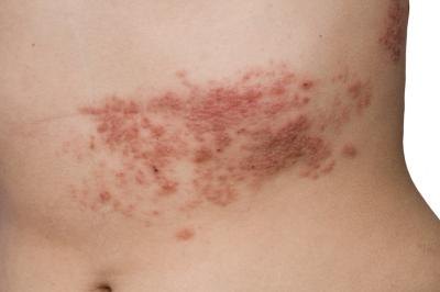 Shingles presents as chronic nerve pain.