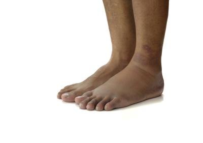 Swelling is another sign of torn cartilage.