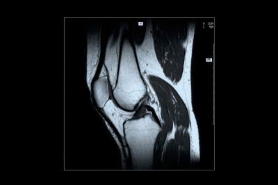 The human knee contains four types of ligaments