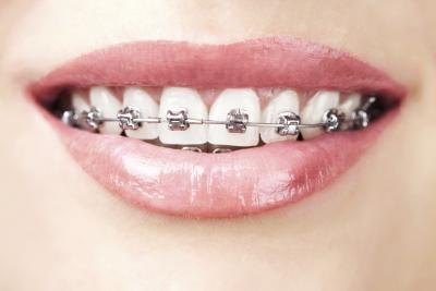 Metal braces.