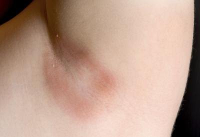 Yeast Infection