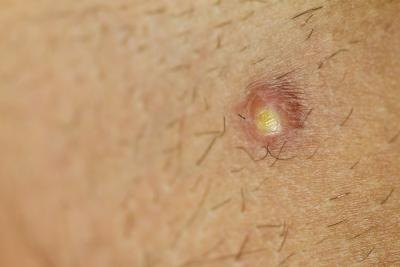 In all stages of the condition, folliculitis, furncles and carbuncles may form a puss that drains.