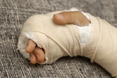 A broken hand may need a cast.