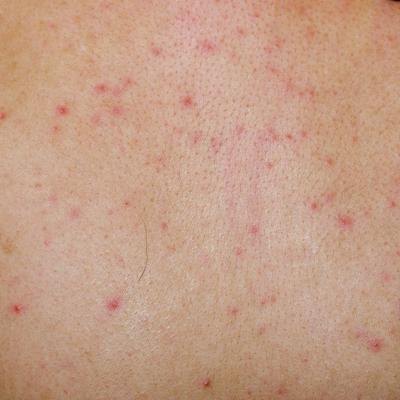 rashes caused by virus #11