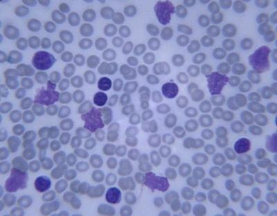 Leukemia is a form of cancer. White blood cells are overproduced in the bone marrow and ultimately begin to overtake red blood cells.