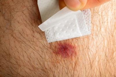 Most common spider bites are mild.