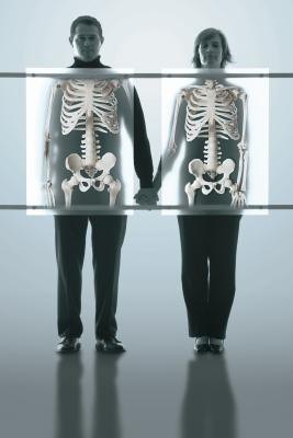 Osteoporosis is a condition in which the bones become brittle and prone to fracture