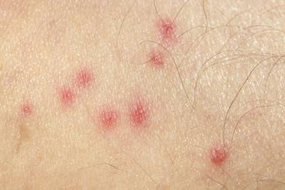 Alternate bug bites.