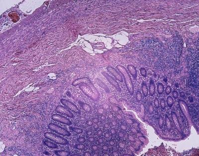 Microscopic image of a inflamed appendix