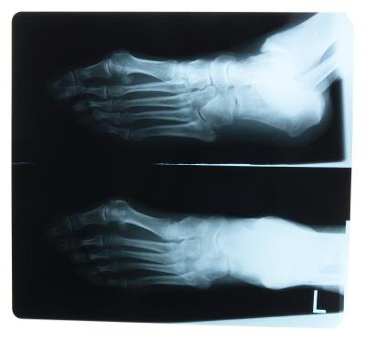 Of course, any standard sprain, break or bruise to the ankle can cause it to swell.