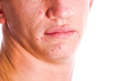 Acne is a short-term effect.