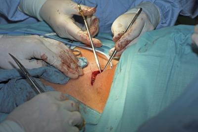 Surgery is the most common type of treatment for thyroid cancer.