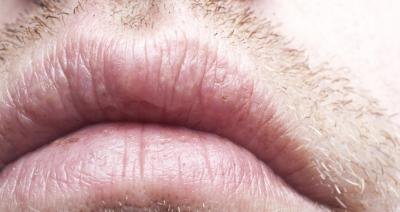 Dry mouth