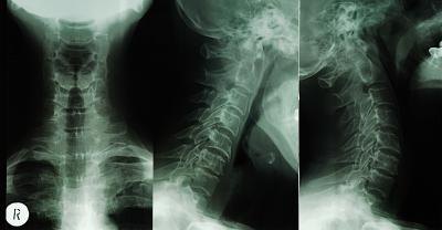 Rheumatoid arthritis commonly affects the vertebrae of the neck.