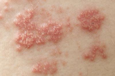 Herpes zoster virus rash.
