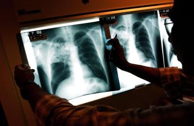 X-rays of tuberculosis affecting a patient's lungs