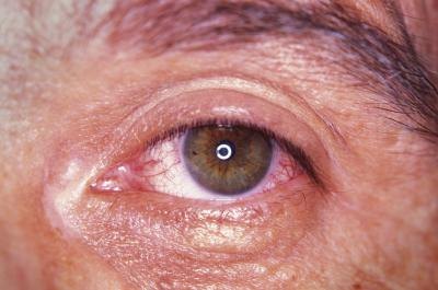 Eyes may become red and swollen.