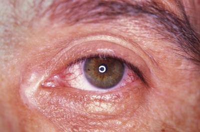 Calcium chloride may be a skin and eye irritant.