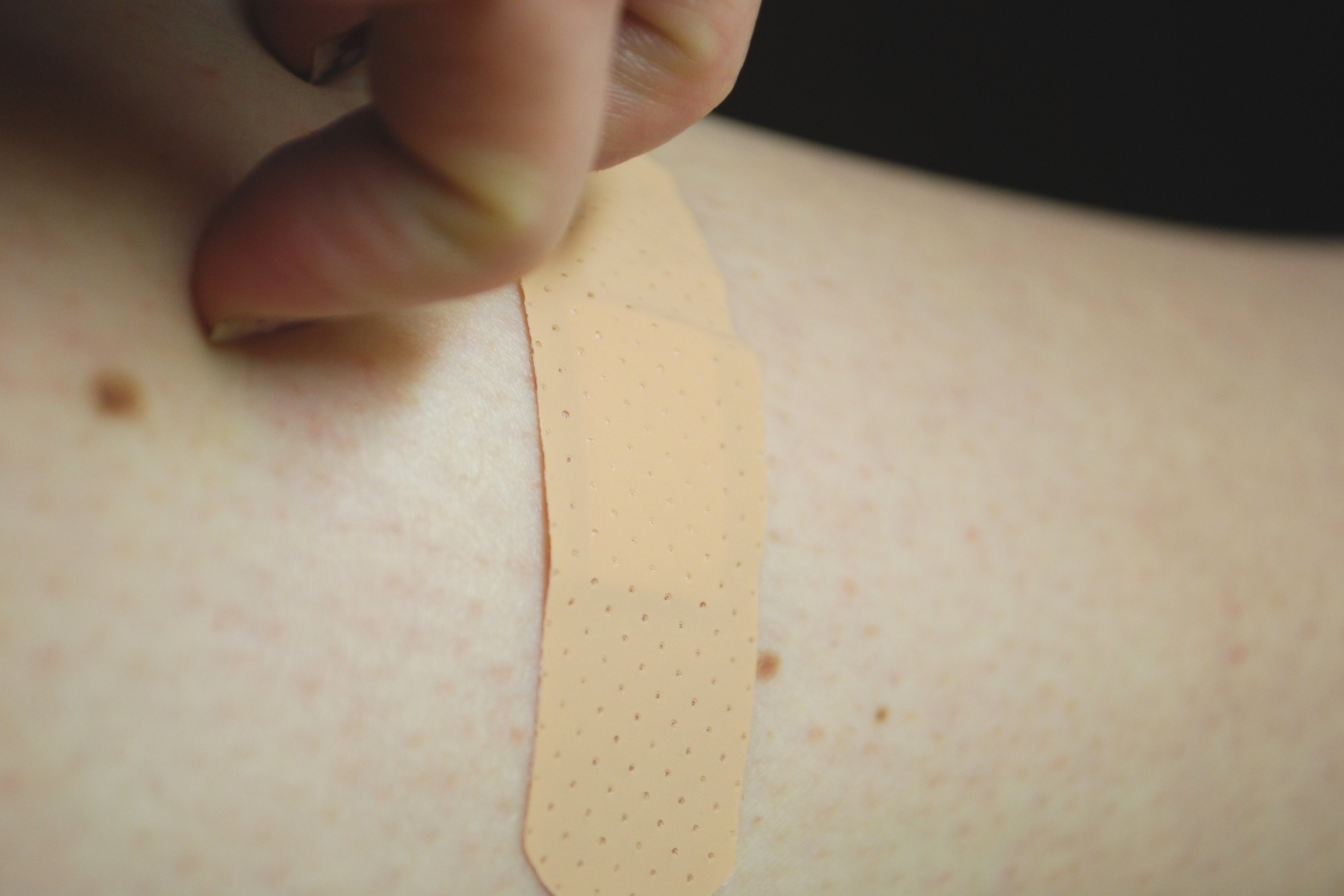 how-to-treat-a-latex-adhesive-allergic-skin-rash-ehow