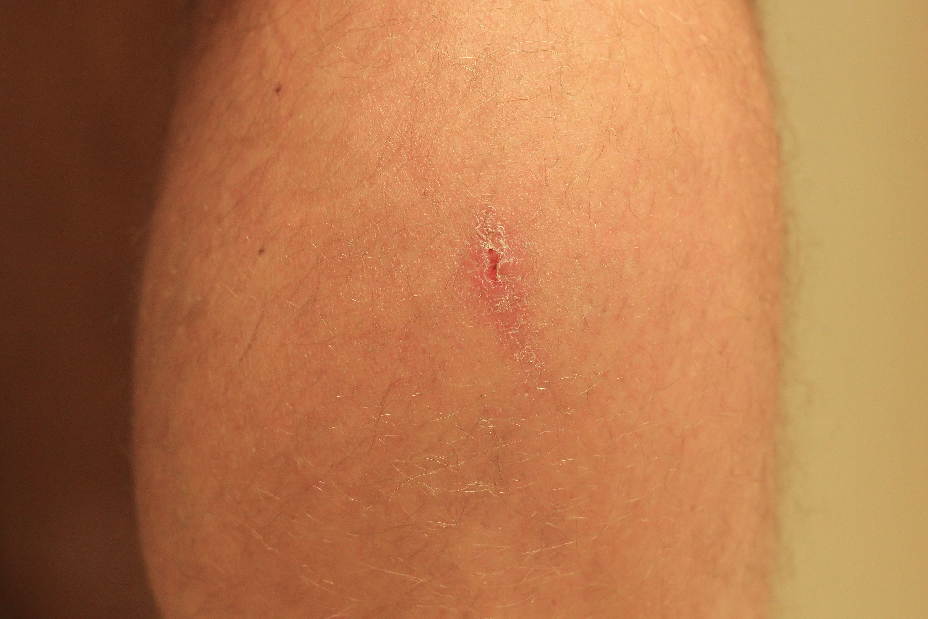 how-to-get-rid-of-leg-scars-caused-by-picking-at-scabs-ehow