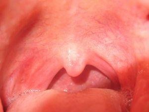 Home Remedy for Mucus Congestion in the Throat Home Remedy for Mucus Congestion in the Throat