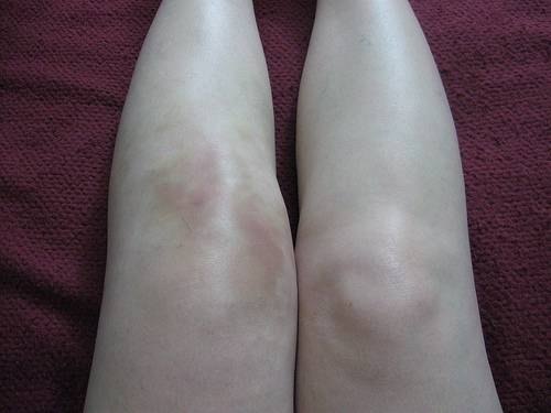swelling and excess fluid in knee
