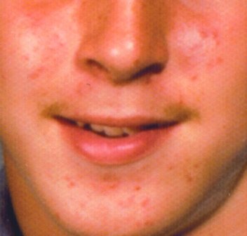 10 Foods for Acne Scars 10 Foods for Acne Scars