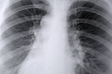 Respiratory updraft breathing treatments are given for chronic obstructive pulmonary disease. Respiratory updraft breathing treatments are given for chronic obstructive pulmonary disease.