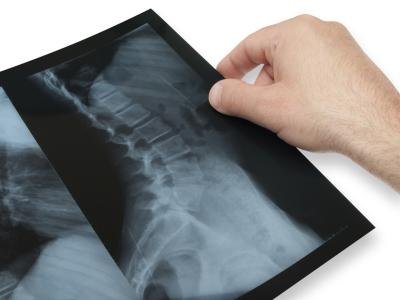 Spinal X-ray. Spinal X-ray.