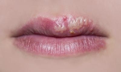 Close up of herpes on mouth. Close up of herpes on mouth.