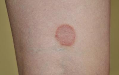 A ringworm infection. A ringworm infection.