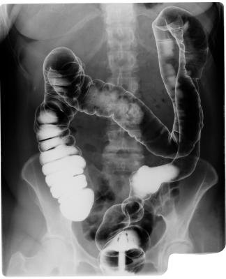 X-ray of intestines and pelvis X-ray of intestines and pelvis