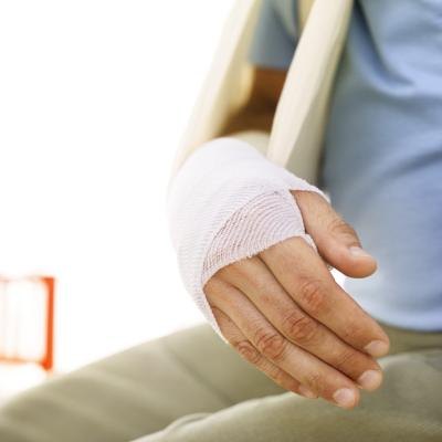 A person with a broken arm in a sling. A person with a broken arm in a sling.