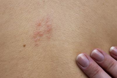 Raised bumps caused by shingles. Raised bumps caused by shingles.