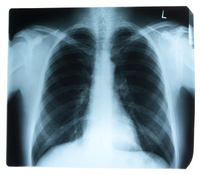 Chest X-ray Chest X-ray