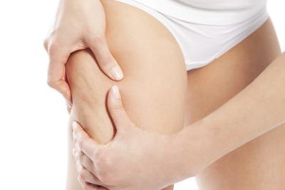 Cellulite on leg. Cellulite on leg.